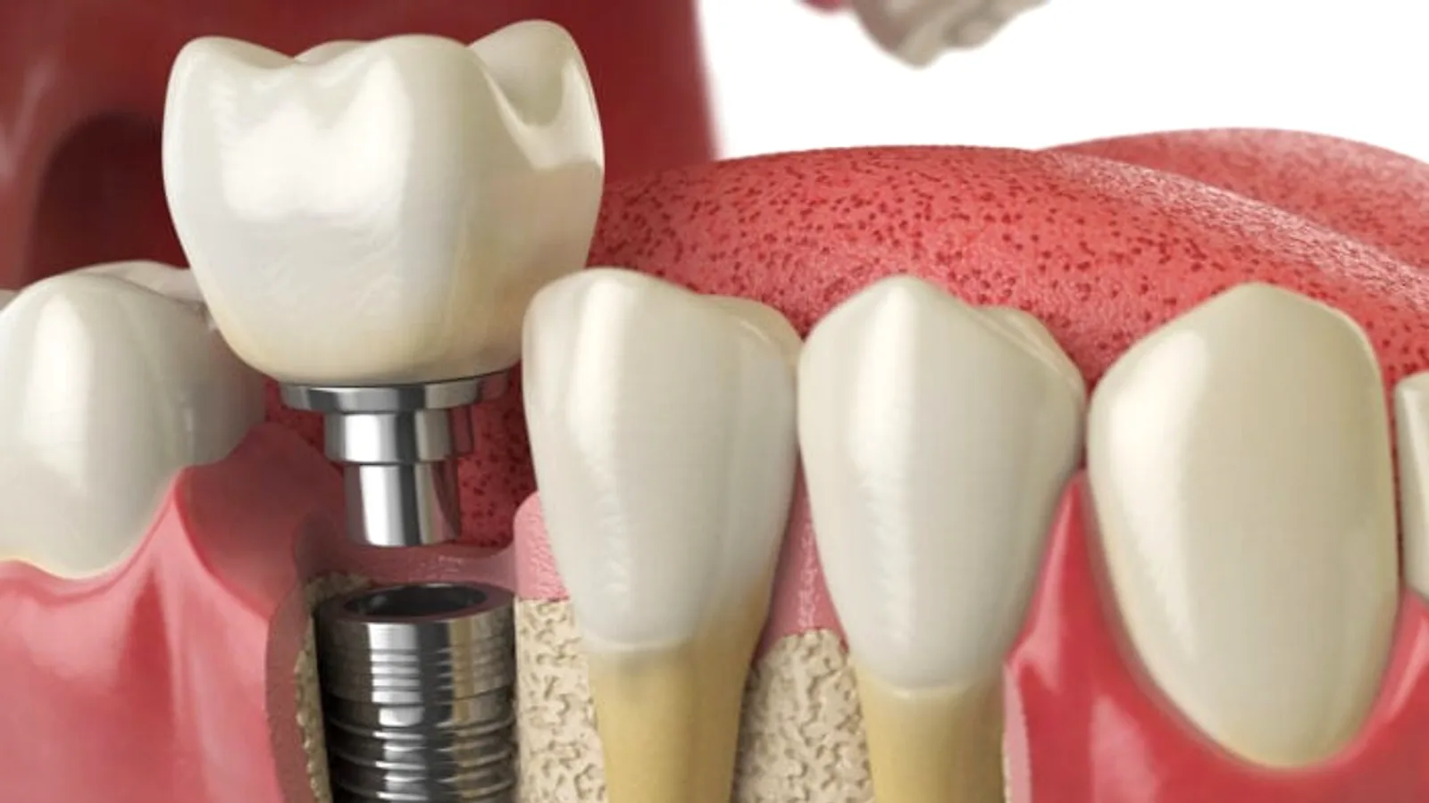 Ilustração de implante dentário e do osso de suporte em corte